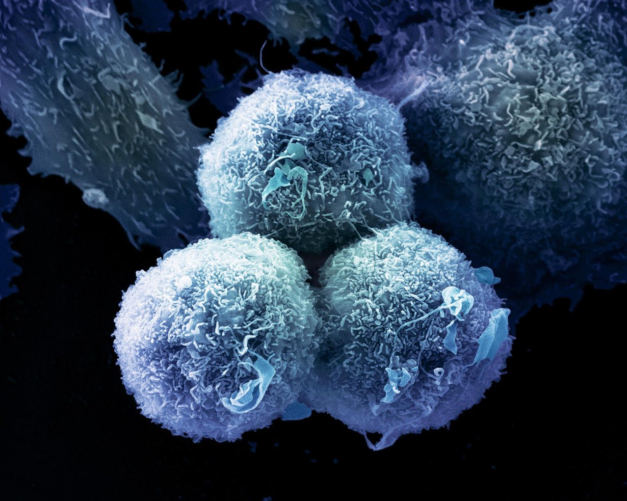 Keuhkosyövän soluja. Syövässä solut alkavat jakaantua hallitsemattomasti, mikä johtaa kasvaimen muodostumiseen. Kuva: ANNE WESTON, FRANCIS CRICK INSTITUTE/SCIENCE PHOTO LIBRARY