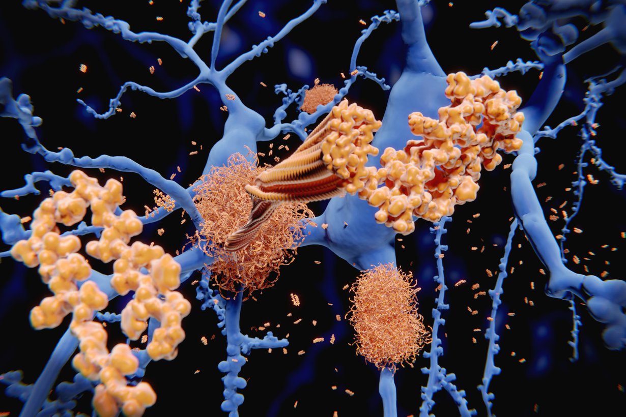 Alzheimerin tauti kerryttää. Kuva: Getty Images