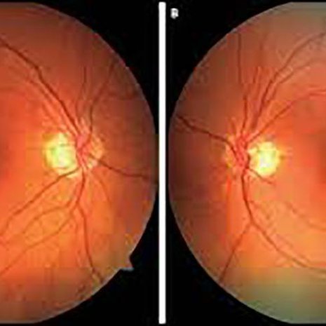 Kuvassa verkkokalvon keskikuoppa eli fovea näkyy tummana, ja sen ympärillä on soluvauriosta kertova tumma rengas. Kuva: <span class="photographer">The New England Journal of Medicine</span>