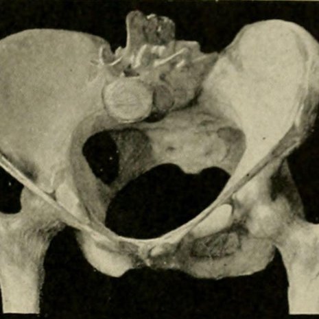 Evoluutiossa ihmislapsen pää kasvoi ja pystyssä kävelevän naisen lantio kapeni. Kuva: <span class="photographer">The American text-book of obstetrics for practitioners and students (1903) / Wikimedia Commons</span>
