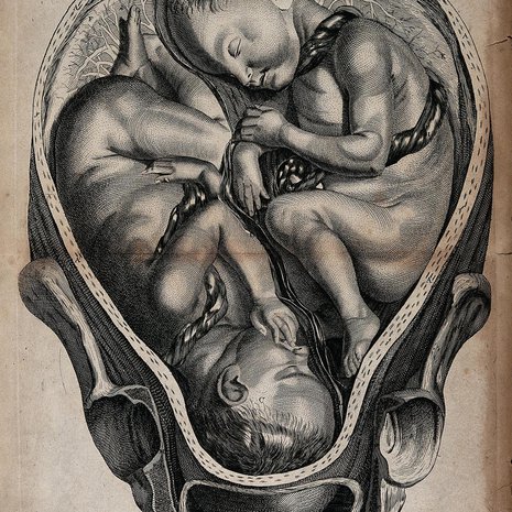 Vanha painokuva kaksosraskaudesta. Kuva: <span class="photographer">Wellcome Library, London</span>