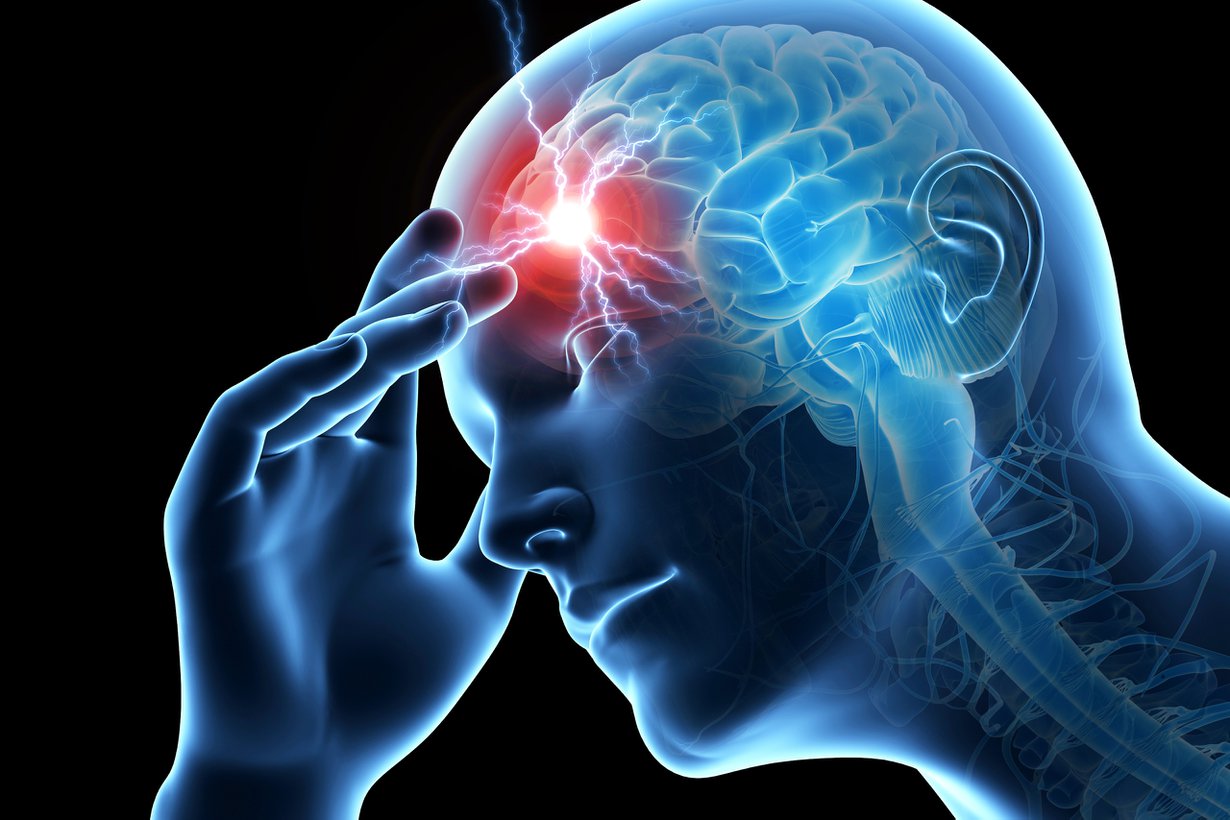 Migreeni ei ole mikä tahansa päänsärky. Rajuimmillaan kohtaus rapauttaa toimintakyvyn päiväkausiksi. Kuva: Shutterstock