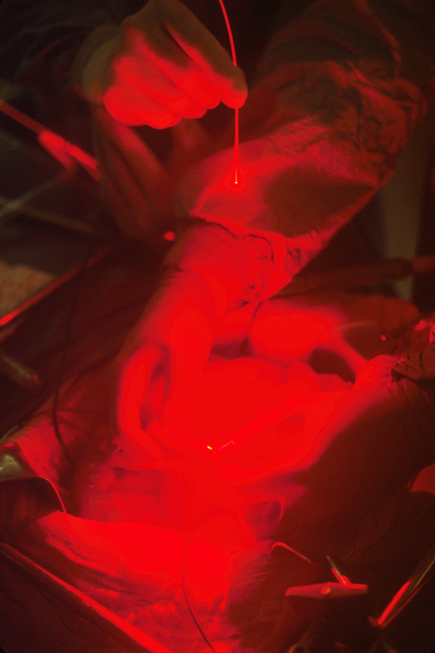 Fotodynaamisessa hoidossa laser tuhoaa syöpäsoluja.
