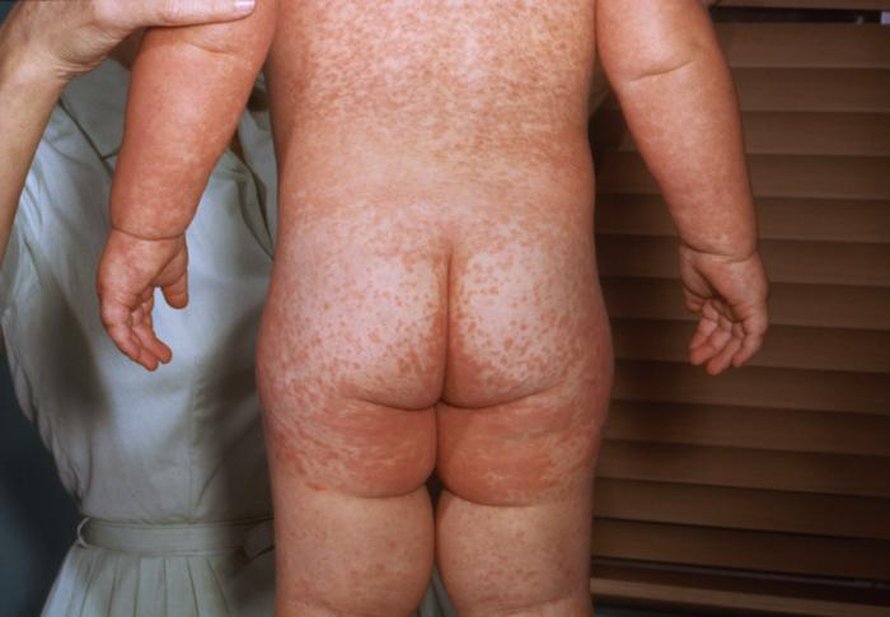 Tältä näytti lapsen tuhkarokko 1963. Kuva: <span class="photographer">United States Department of Health and Social Services / Wikimedia Commons</span>