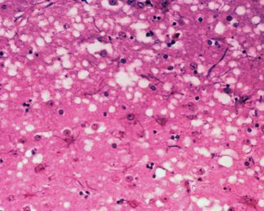 Aivokudoksessa näkyy hullun lehmän taudista kärsivän naudan mikroskooppisia reikiä harmaassa aineessa.
Kuva: <span class="photographer"><A HREF=http://en.wikipedia.org/wiki/File:Histology_bse.jpg>Wikimedia Commons</A>.</span>