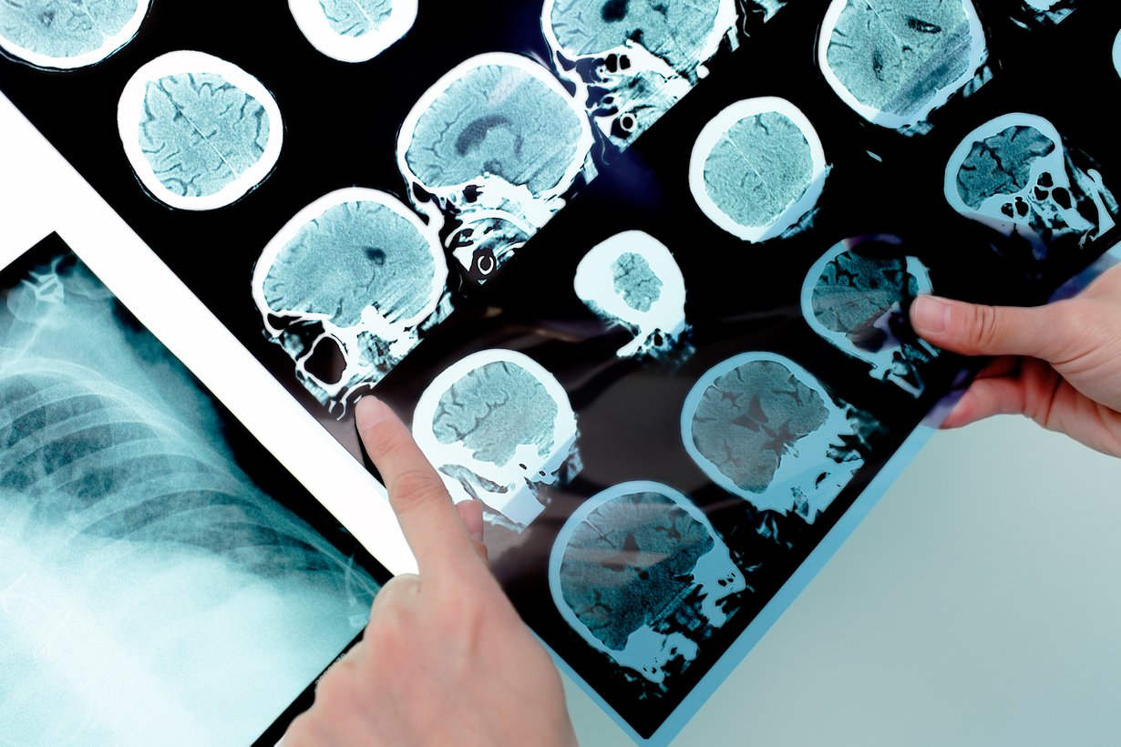 Kulkuproteiini lupailee aikaisempaa diagnoosia. Nykyään Alzheimer löytyy aivokuvista vasta pitkälle edettyään. Kuva: Shutterstock