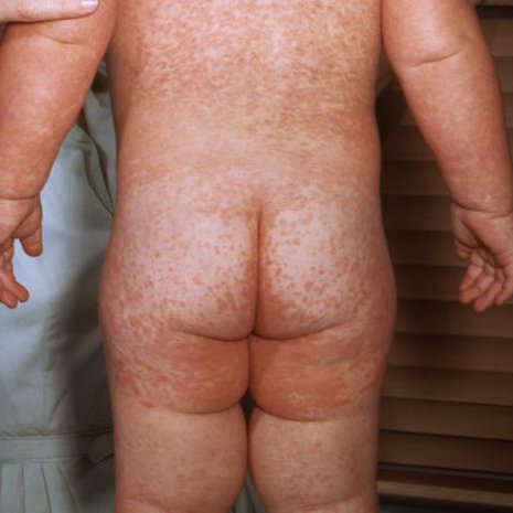 Tältä näytti lapsen tuhkarokko 1963. Kuva: <span class="photographer">United States Department of Health and Social Services / Wikimedia Commons</span>