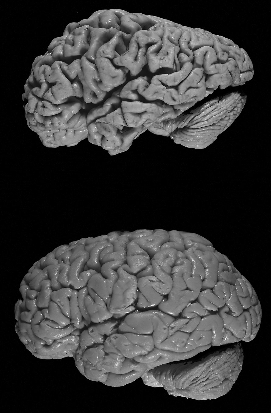 Alzheimerin taudissa aivot kutistuvat.