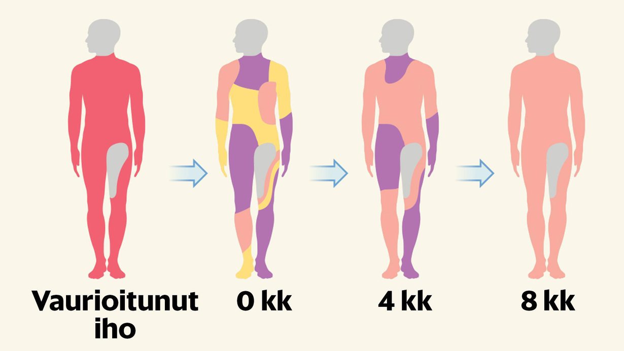 Seitsemänvuotias poika sai uuden ihon, joka toimii täysin terveesti. Poika pystyy nyt pelaamaan jalkapalloakin. Kuva Nature, News&Views