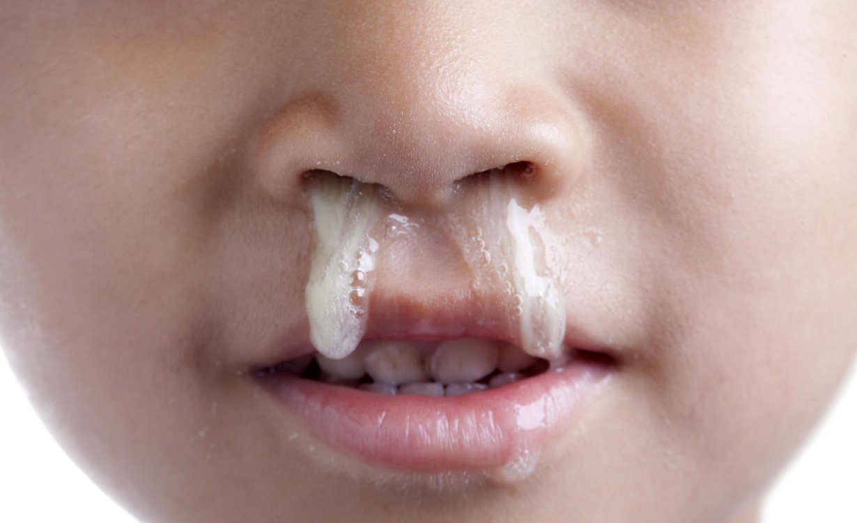 Paksua syntyy flunssassa. Kuva: Shutterstock