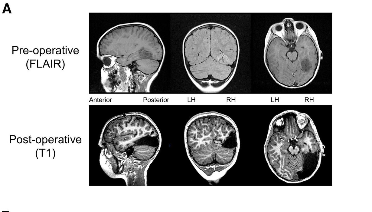 Ylemmät magneettikuvat pojan aivoista näyttävät, miten laajalle kasvain oli levinnyt. Alemmista käy ilmi tilanne leikkauksen jälkeen. Kuva: Behrmann et al. / Cell Reports 2018
