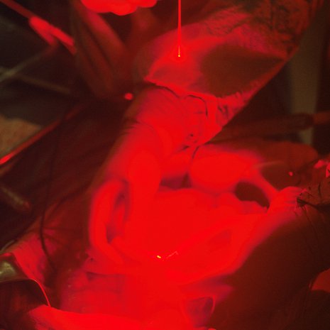Fotodynaamisessa hoidossa laser tuhoaa syöpäsoluja.