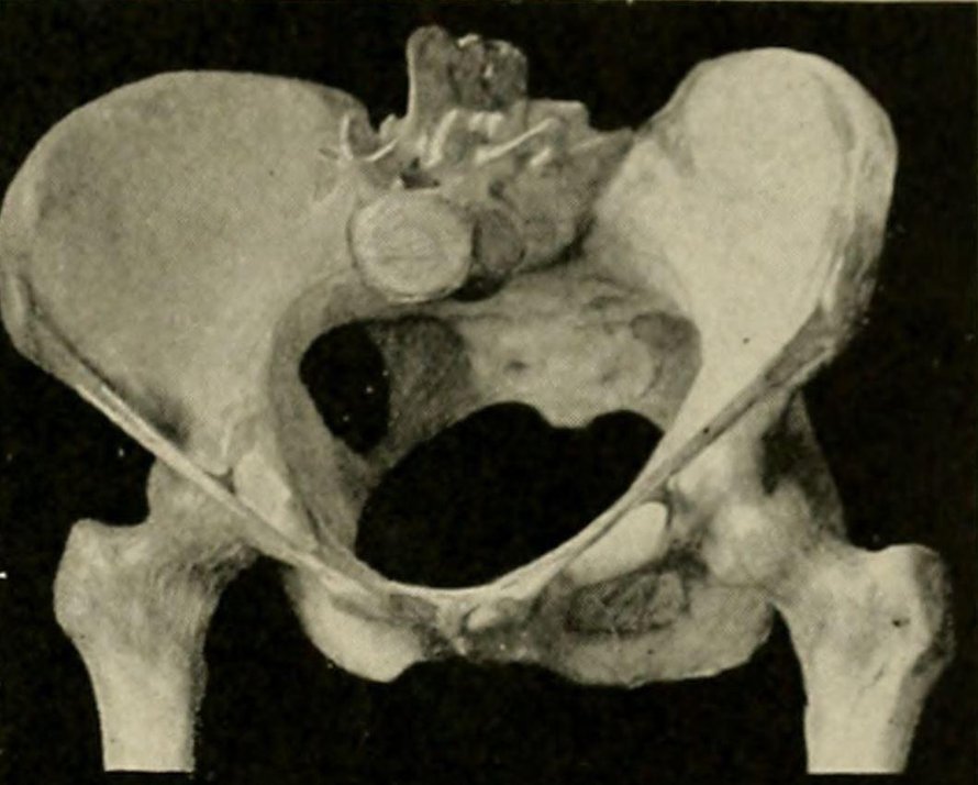 Evoluutiossa ihmislapsen pää kasvoi ja pystyssä kävelevän naisen lantio kapeni. Kuva: <span class="photographer">The American text-book of obstetrics for practitioners and students (1903) / Wikimedia Commons</span>