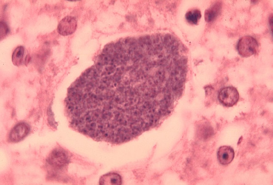 Malaria on tyypillinen tauti, jonka tartunnoissa on usein mukana monia erilaisia malariakantoja. Yhdysvaltain tartuntatautiviraston kuvassa malarialoisioita maksakudoksessa.