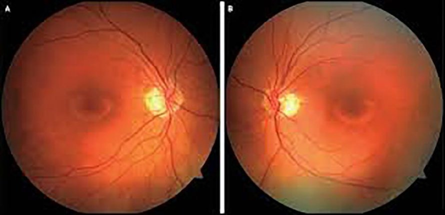 Kuvassa verkkokalvon keskikuoppa eli fovea näkyy tummana, ja sen ympärillä on soluvauriosta kertova tumma rengas. Kuva: <span class="photographer">The New England Journal of Medicine</span>