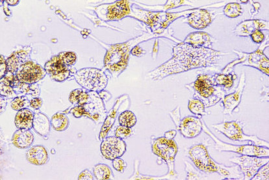 Syöpäsoluja. Kuva: <span class="photographer">CDC.</span>