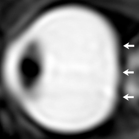 Astronautin silmä pitkän painottomuudessa oleskelun jälkeen. Silmämunan takaseinä on painunut. Kuva: <span class="photographer">Radiological Society of North America</span>