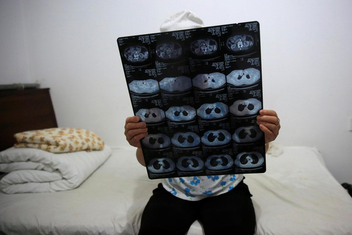 Kiinalainen syöpäpotilas tutkii röntgenkuvia sairaalassa Pekingissä. Kuva ei liity uutisen käsittelemään tutkimukseen. Kuva: KIM KYUNG-HOON / Reuters
