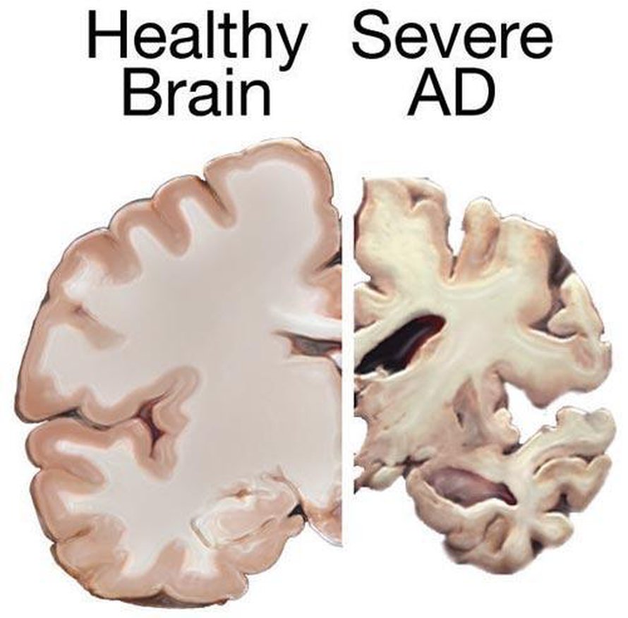 Alzheimerin tauti kutistaa aivoja. Kuvassa vasemmalla on terveet aivot, oikealla vakavaa Alzheimerin tautia sairastavan aivot. Kuva: <span class="photographer">National Institutes of Health</span>