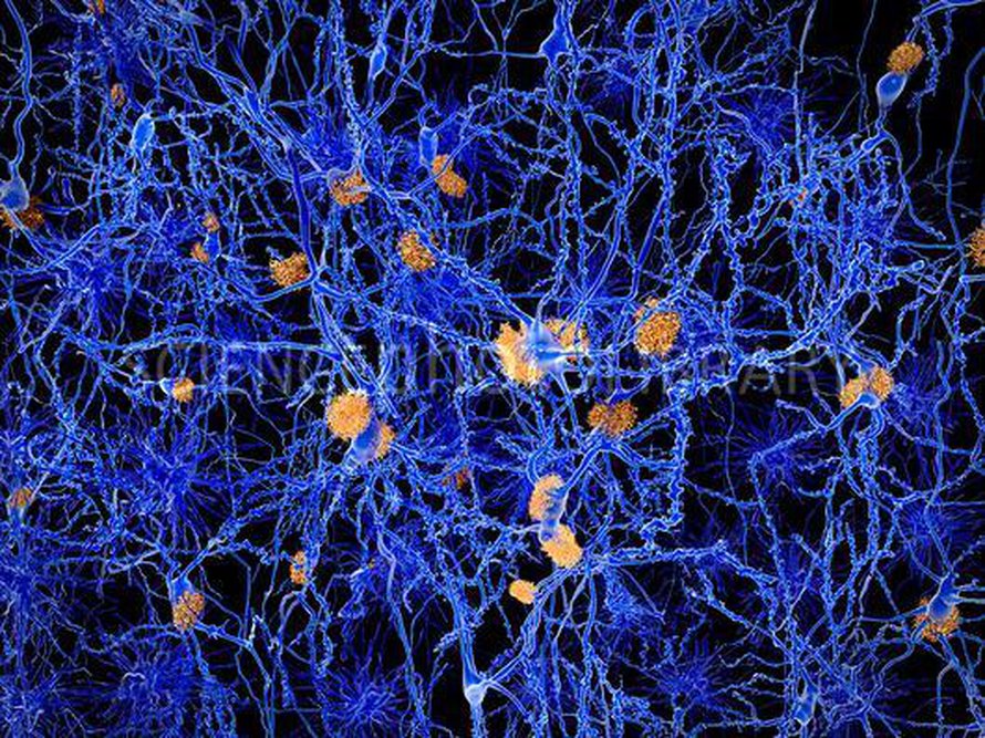 Alzheimerin taudissa aivosolut työntävät beeta-amyloidia ulkopuolelleen, jonne se muodostaa plakkikertymiä. Kuva: <span class="photographer">Juan Gaertner / Science Photo Library</span>
