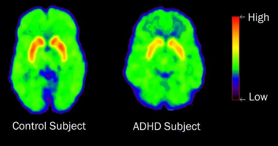 Yhdysvaltalaistutkijoiden PET-kuvissa näkyy, että adhd-häiriöisen aivojen palkkiojärjestelmä työskentelee tavallista tehottomammin.