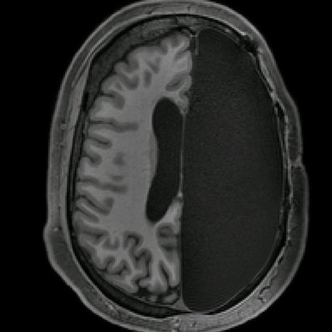 Ihminen voi elää normaalisti, vaikka aivoista puuttuisi suuri osa. Kuva: <span class="photographer">Caltech Brain Imaging Center</span>