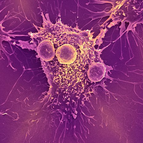Elimistön puolustuksen T-solut näkyvät pyöreinä syöpäsolun ympärillä. Kuva: <span class="photographer">STEVE GSCHMEISSNER/SCIENCE PHOTO LIBRARY</span>