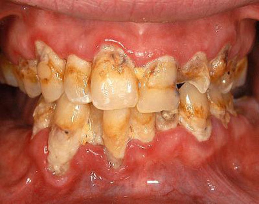 Metamfetamiinihymy. Kuva: <span class="photographer">American Dental Association</span>