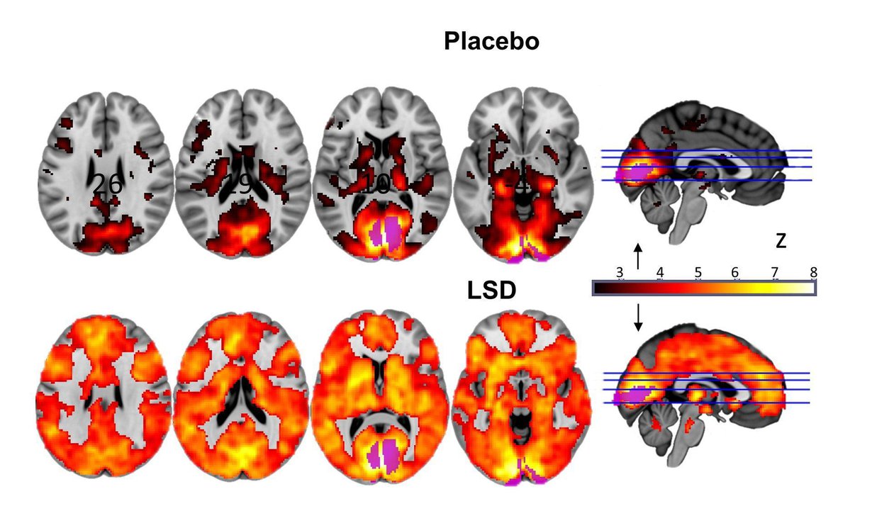 Alemmat aivokuvat kertovat, miten laajalti aivot reagoivat lsd:n vaikutuksen alaisena. Ylemmät aivot kuuluvat lumeryhmäläisille. Kuva: Imperial College/Beckley Foundation