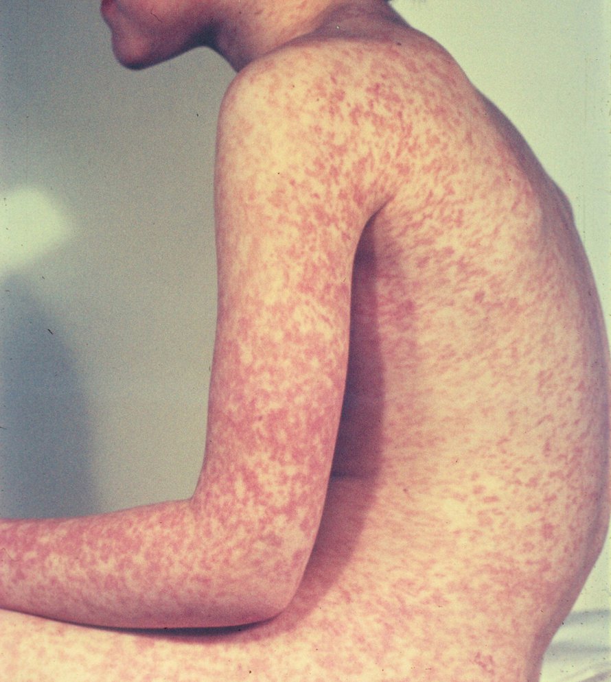 Tuhkarokolle tunnusomainen ihottuma alkaa 3-5 vuorokauden kuluttua ja kestää runsaan viikon. Kuva: <span class="photographer">American Academy of Pediatrics / Wikimedia Commons. </span>