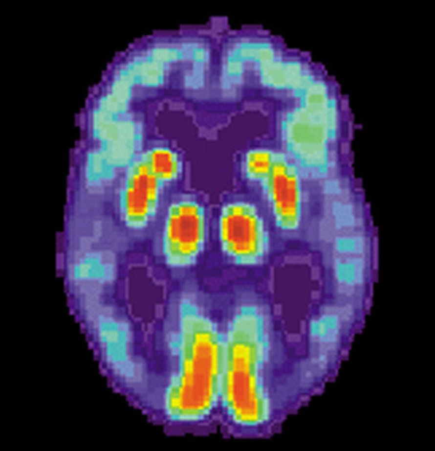 PET-kuva Alzheimerin tautia sairastavan henkilön aivoista, joiden ohimolohkoissa näkyy toiminnan heikkeneminen. Kuva: <span class="photographer"><A HREF=http://en.wikipedia.org/wiki/File:PET_Alzheimer.jpg>Wikimedia Commons</A>.</span>