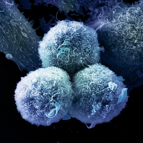 Keuhkosyövän soluja. Syövässä solut alkavat jakaantua hallitsemattomasti, mikä johtaa kasvaimen muodostumiseen. Kuva: <span class="photographer">ANNE WESTON, FRANCIS CRICK INSTITUTE/SCIENCE PHOTO LIBRARY</span>