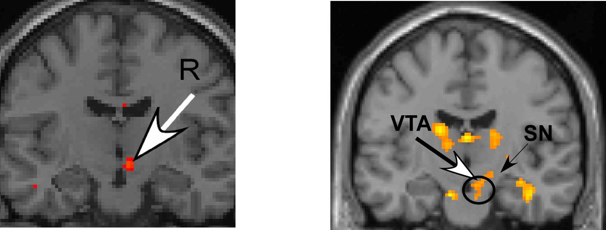 fMRI osoittaa, että vastarakastuneiden aivot (vas) reagoivat rakastetun kuvaan samaan tapaan kuin pitkään rakastaneiden (oik).
