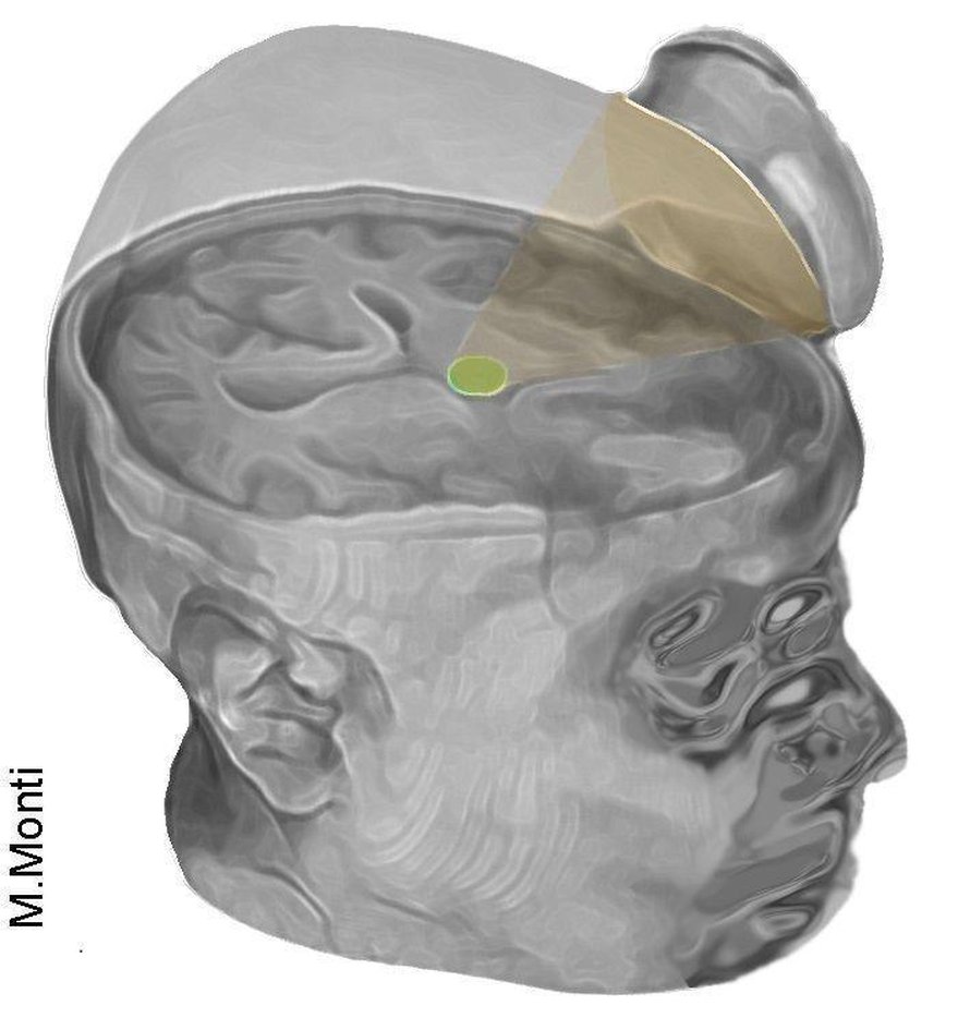 Talamusta aktivoitiin suunnilleen teevadin kokoisella ultraäänilaitteella. Kuva: <span class="photographer">Martin Monti, University of California, Los Angeles</span>